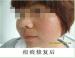 去除痘坑痘疤的方法
