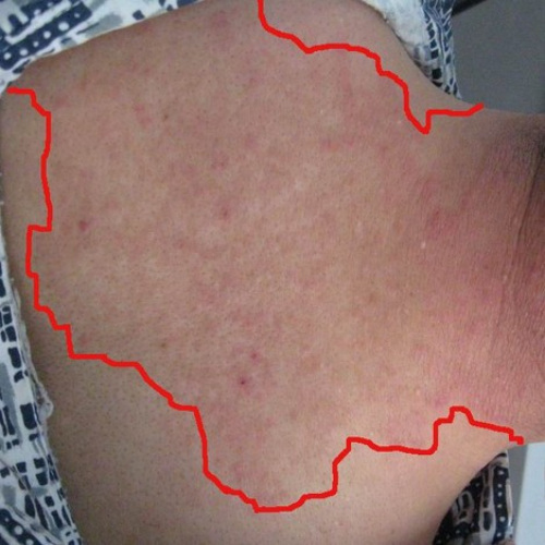 山东最好的治体癣偏方