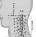 臨沂專治頸椎病