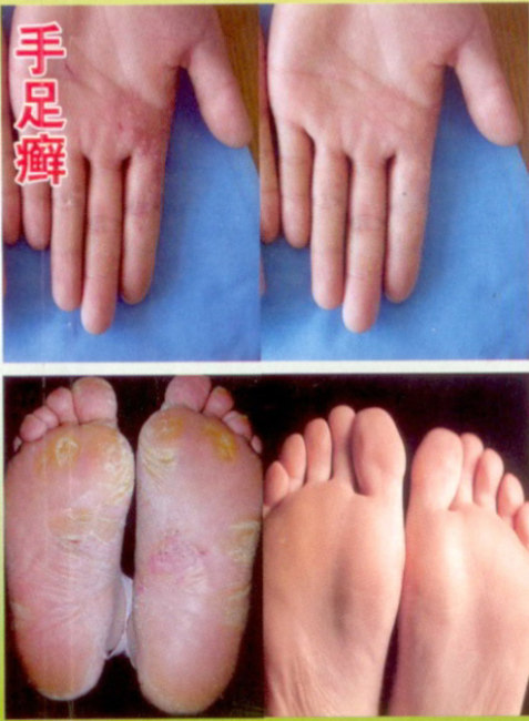 足癣是皮肤癣菌病中最常见的疾病