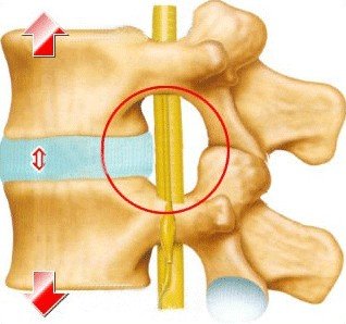 椎间管狭窄的治疗费用椎间管狭窄怎么治疗椎间