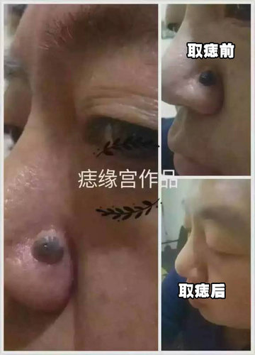 眉山痣缘宫取痣国庆后上班通知