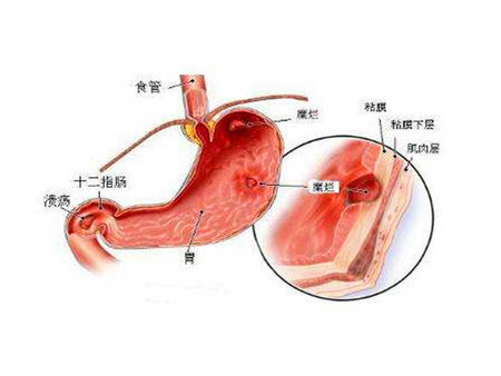 膽汁反流性胃炎的癥狀——想要胃炎治*應該去哪裏