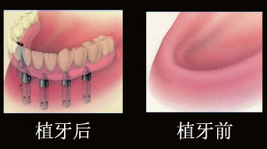 廊坊21歲戴牙套——河北全套廊坊牙齒種植推薦