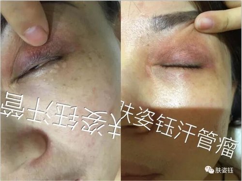 激光祛斑后为什么会反黑