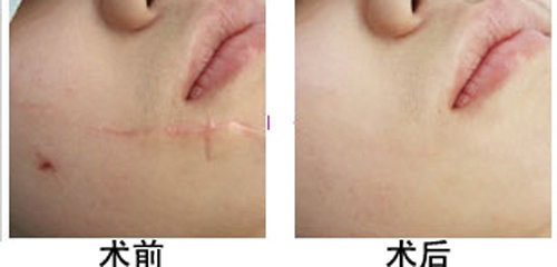 三种蔬菜可以祛疤痕