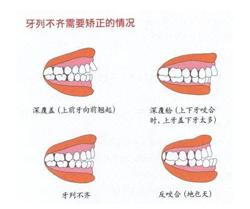 牙齿矫正需要经历哪些过程