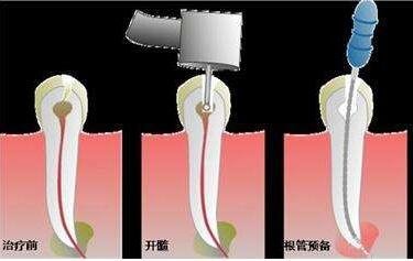 发展到什么样的牙病需要做根管治疗