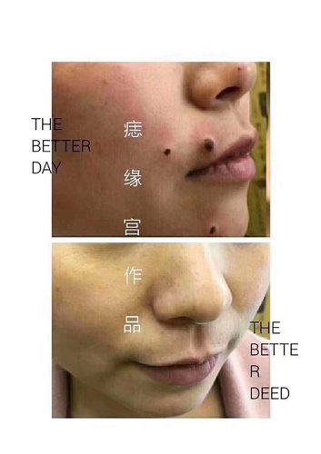眉山哪里可以祛痣