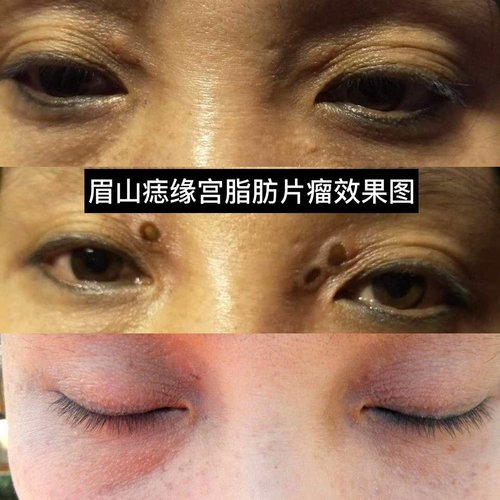眉山痣缘宫取痣国庆预约中