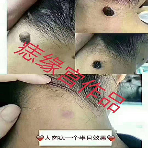 眉山祛痣中心说痣
