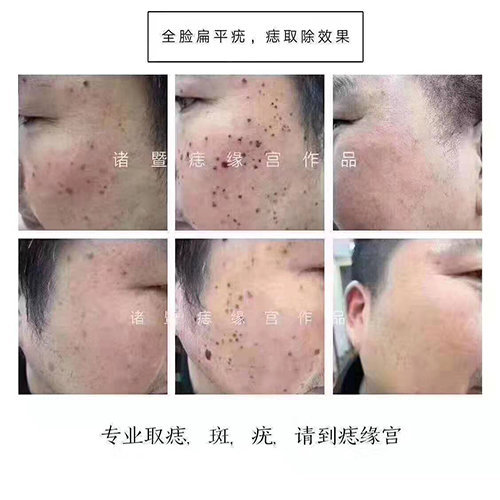 扁平疣该怎么祛除