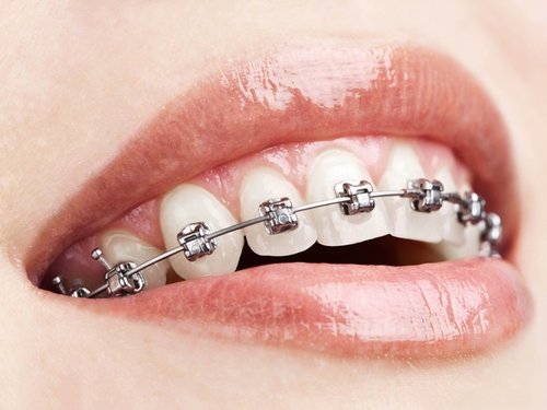 眉山牙齒矯正診所：為何必須牙齒矯正？