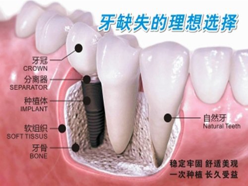 牙周病是牙槽骨收縮的原因