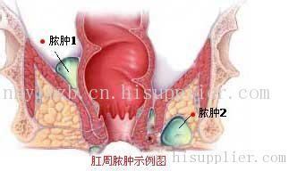 怎么预防肛周脓肿?