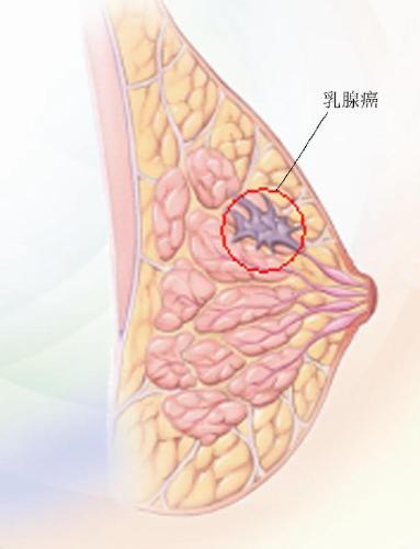 乳腺癌中药秘方