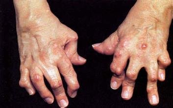 类风湿性关节炎治疗,类风湿性关节炎如何食补,类风湿食补,山西类风湿